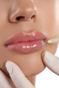 2. Voluminización de labios
